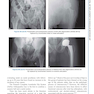 Complex Primary Total Hip Replacement 1st Edition