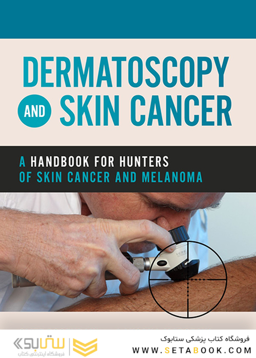 Dermatoscopy and Skin Cancer : A handbook for hunters of skin cancer and melanoma 2019 درماتوسکوپی و سرطان پوست: کتاب راهنما سرطان پوست