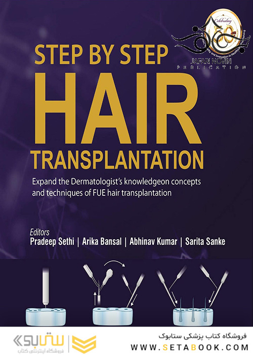 Step by Step Hair Transplantation 2019 کاشت مو به صورت مرحله به مرحله