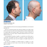 Step by Step Hair Transplantation 2019 کاشت مو به صورت مرحله به مرحله