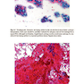 The Bethesda System for Reporting Thyroid Cytopathology, 2nd Edition 2018