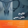 تلقیح داخل رحمی