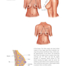 Augmentation Mastopexy: Mastering the Art in the Management of the Ptotic