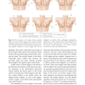 Augmentation Mastopexy: Mastering the Art in the Management of the Ptotic