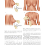 Augmentation Mastopexy: Mastering the Art in the Management of the Ptotic