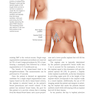 Augmentation Mastopexy: Mastering the Art in the Management of the Ptotic