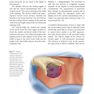 Augmentation Mastopexy: Mastering the Art in the Management of the Ptotic
