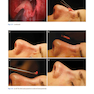 Photographic Atlas of Rhinoplasty : Problem-solving and Troubleshooting