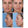 Photographic Atlas of Rhinoplasty : Problem-solving and Troubleshooting