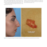 Photographic Atlas of Rhinoplasty : Problem-solving and Troubleshooting