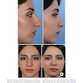 Photographic Atlas of Rhinoplasty : Problem-solving and Troubleshooting