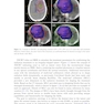 Intensity Modulated Radiation Therapy : A Clinical Overview 2021