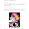 Intensity Modulated Radiation Therapy : A Clinical Overview 2021