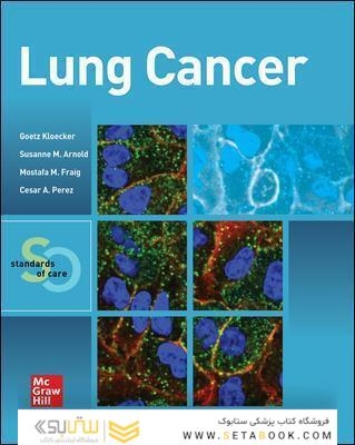 Lung Cancer: Standards of Careسرطان ریه: استانداردهای مراقبت