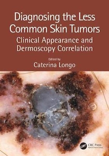 عکس Diagnosing the Less Common Skin Tumors : Clinical Appearance and Dermoscopy Correlation2019