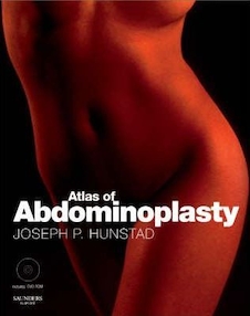 عکس Atlas of Abdominoplasty