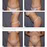 Atlas of Abdominoplasty