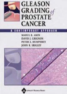 عکس درجه بندی سرطان پروستات