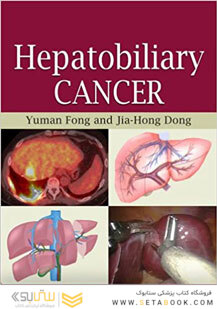 Hepatobiliary Cancer 1st Edicion
