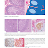 Atlas of Differential Diagnosis in Neoplastic Hematopathology2021