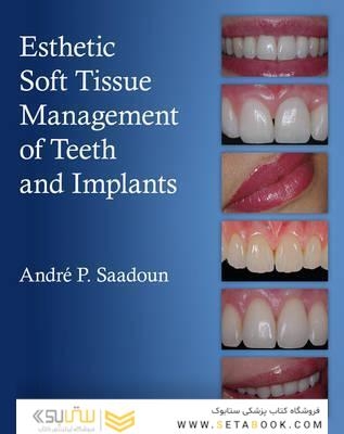 Esthetic Soft Tissue Management of Teeth and Implants