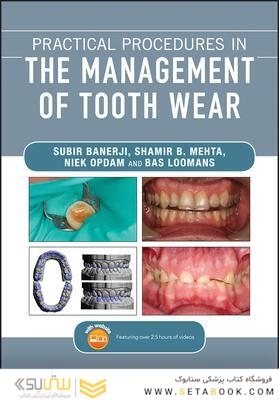 Practical Procedures in the Management of Tooth Wear