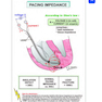 Cardiac Pacemakers and Resynchronization Step by Step