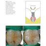 Management of Deep Carious Lesions 2018