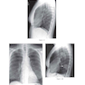 Felson’s PRINCIPLES OF CHEST ROENTGENOLOGY