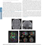 HARRISONS PRINCIPLES OF INTERNAL MEDICINE Part Neurologic Disorders