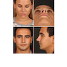 Aesthetic Septorhinoplasty 2021