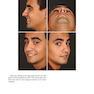 Aesthetic Septorhinoplasty 2021
