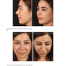 Aesthetic Septorhinoplasty 2021