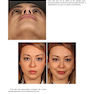Aesthetic Septorhinoplasty 2021
