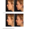 Aesthetic Septorhinoplasty 2021