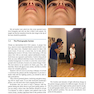 Aesthetic Septorhinoplasty 2021
