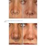 Aesthetic Septorhinoplasty 2021