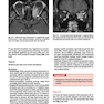 Cranial Nerves: Anatomy, Pathology, Imaging