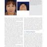 Global Rhinoplasty: A Multicultural Approach 1st Edicion 2023