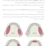 طراحی پروتز پارسیل (اصول و مبانی)