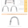 طراحی پروتز پارسیل (اصول و مبانی)