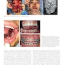 Plastic Surgery Neligan Volume 3: Craniofacial, Head and Neck Surgery and Pediatric Plastic Surgery 5th Edition 2023