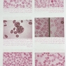 ترجمه کامل هاریسون 2022 بیماری  های هماتولوژی