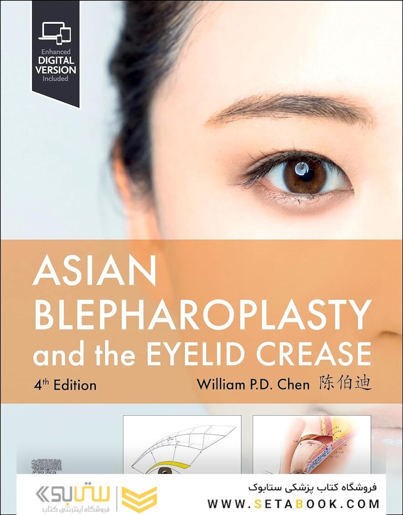 Asian Blepharoplasty and the Eyelid Crease  4th Edition