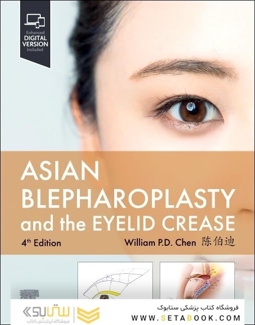 Asian Blepharoplasty and the Eyelid Crease 2024