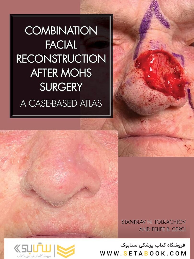 Combination Facial Reconstruction after Mohs Surgery: A Case Based Atlas 1st Edition