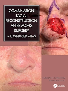 عکس Combination Facial Reconstruction after Mohs Surgery: A Case Based Atlas 1st Edition