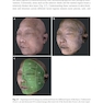 Thread Lifting Techniques for Facial Rejuvenation and Recontouring