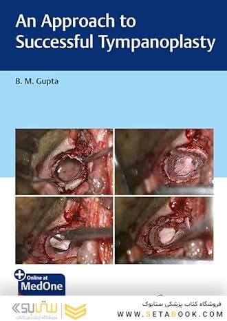An Approach to Successful Tympanoplasty 1st Edition