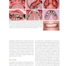 Horizontal and Vertical Bone Augmentation for Dental Implant Therapy